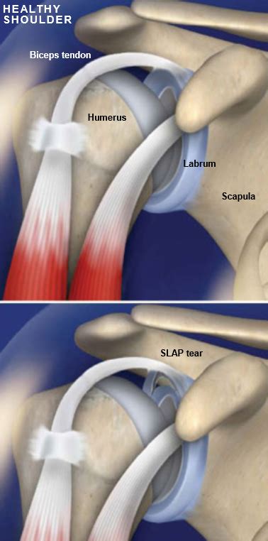 slap tear test biceps|slap tear locations.